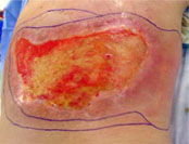Desquamation humide à 3 mois post-irradiation