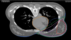 Radiothérapie pour le cancer du sein